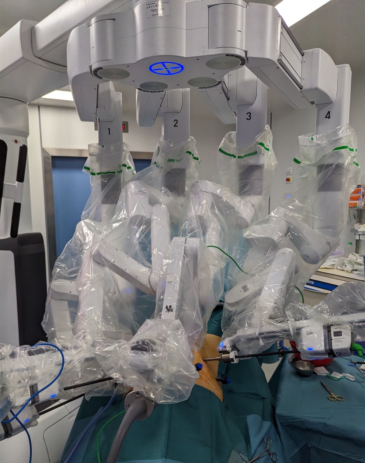 Brazos articulados del robot da Vinci durante cirugía urológica mínimamente invasiva en CDMX